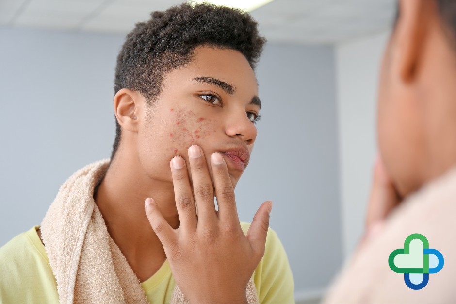 acne treatments