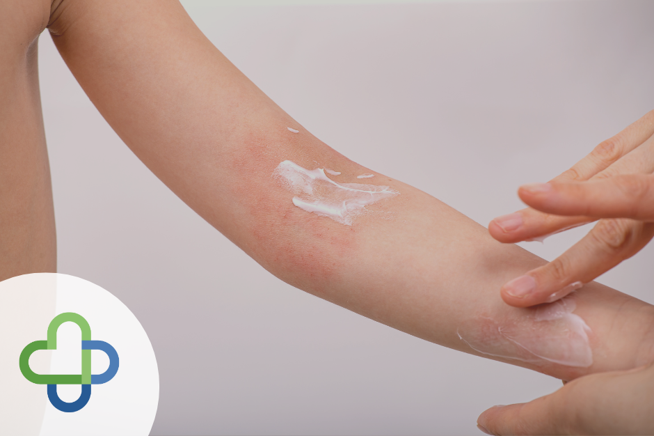 Busting Common Myths About Eczema